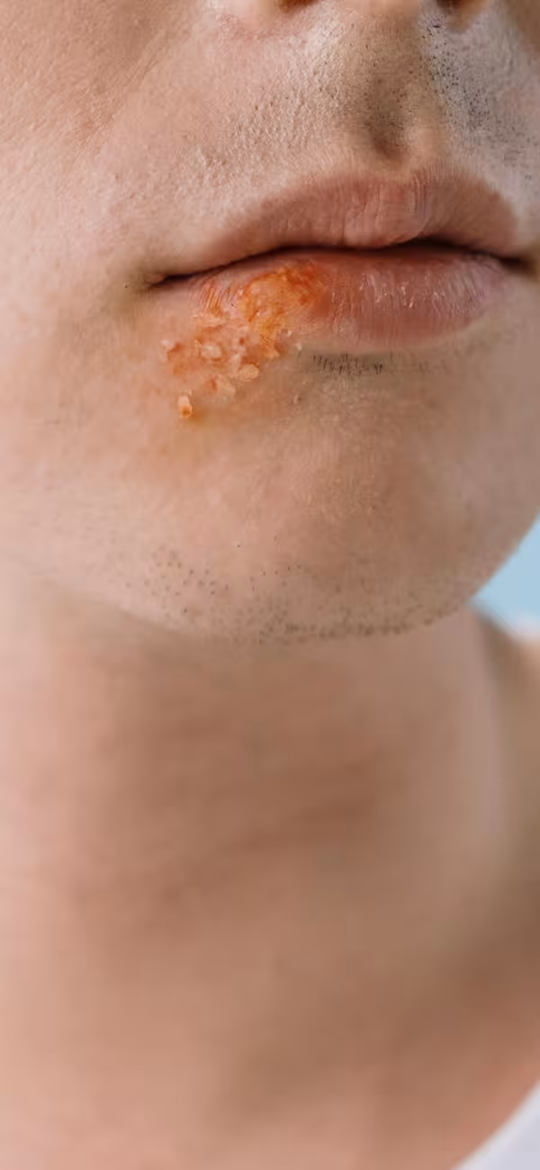 Herpes - SOS Homeopatia