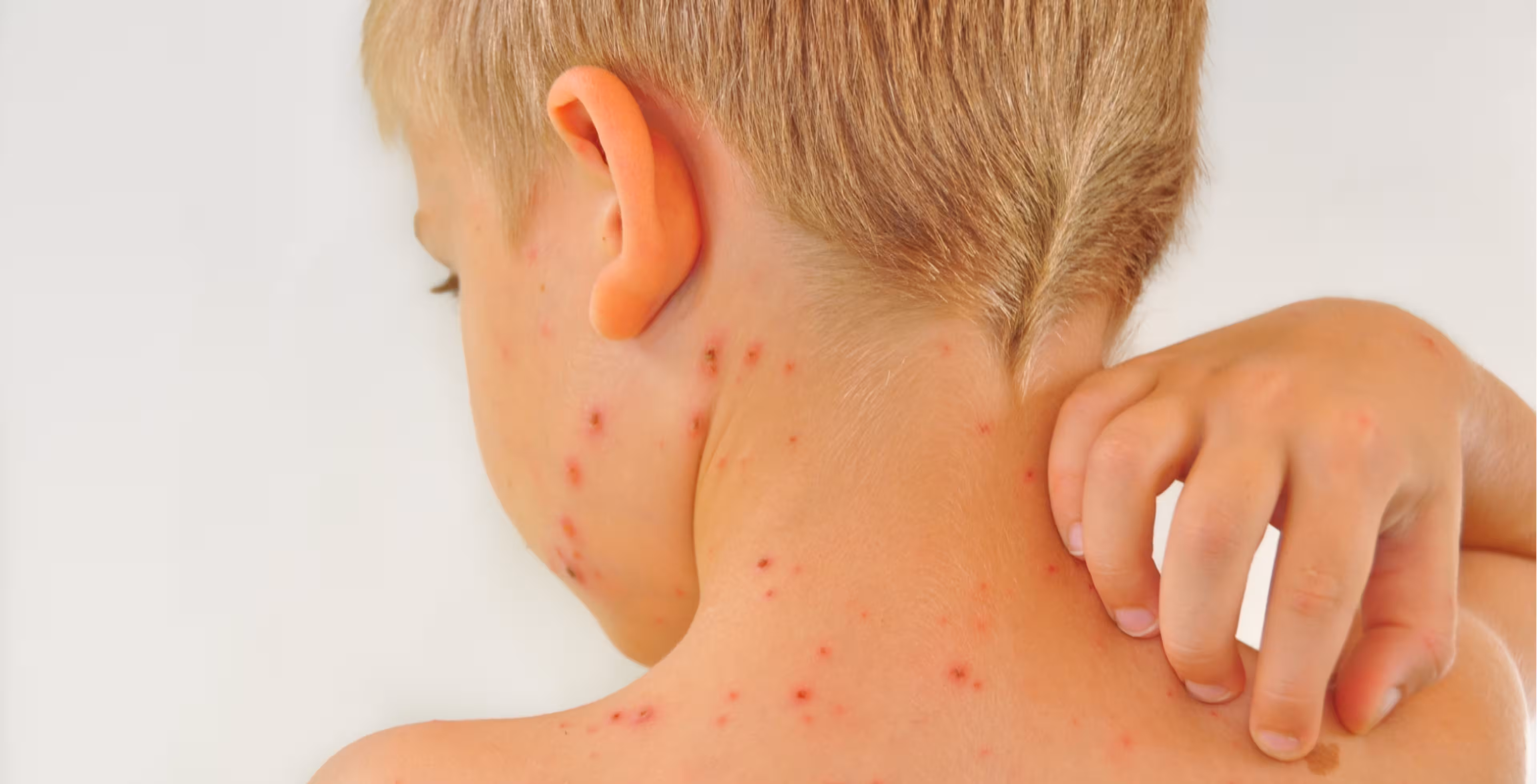 Pýtate sa pediatričky: Ako prežiť ovčie kiahne čo najpohodlnejšie