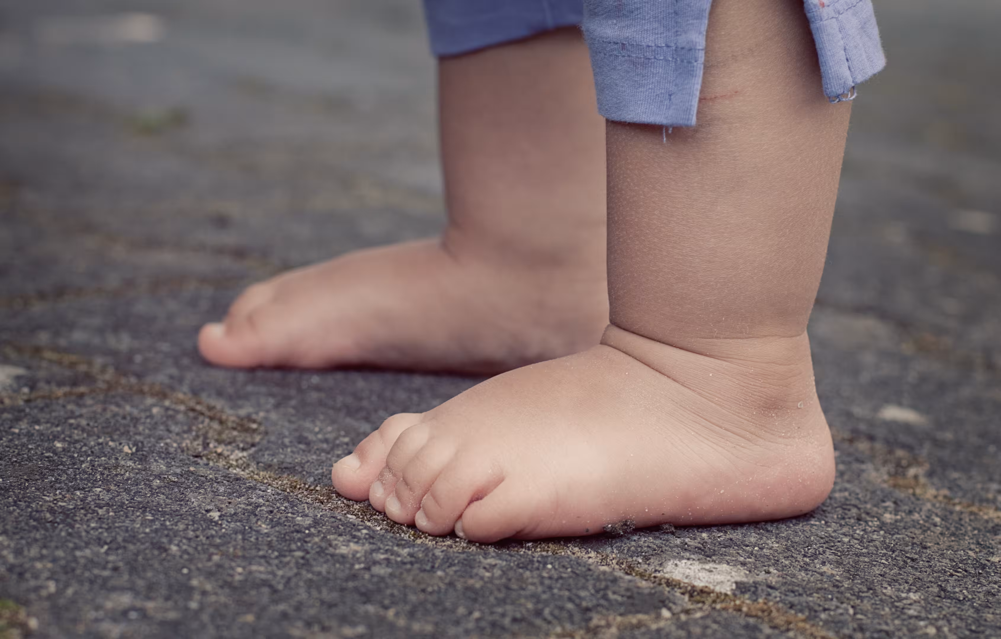 Nevhodná obuv u detí môže spôsobiť alebo zhoršiť ploché nohy