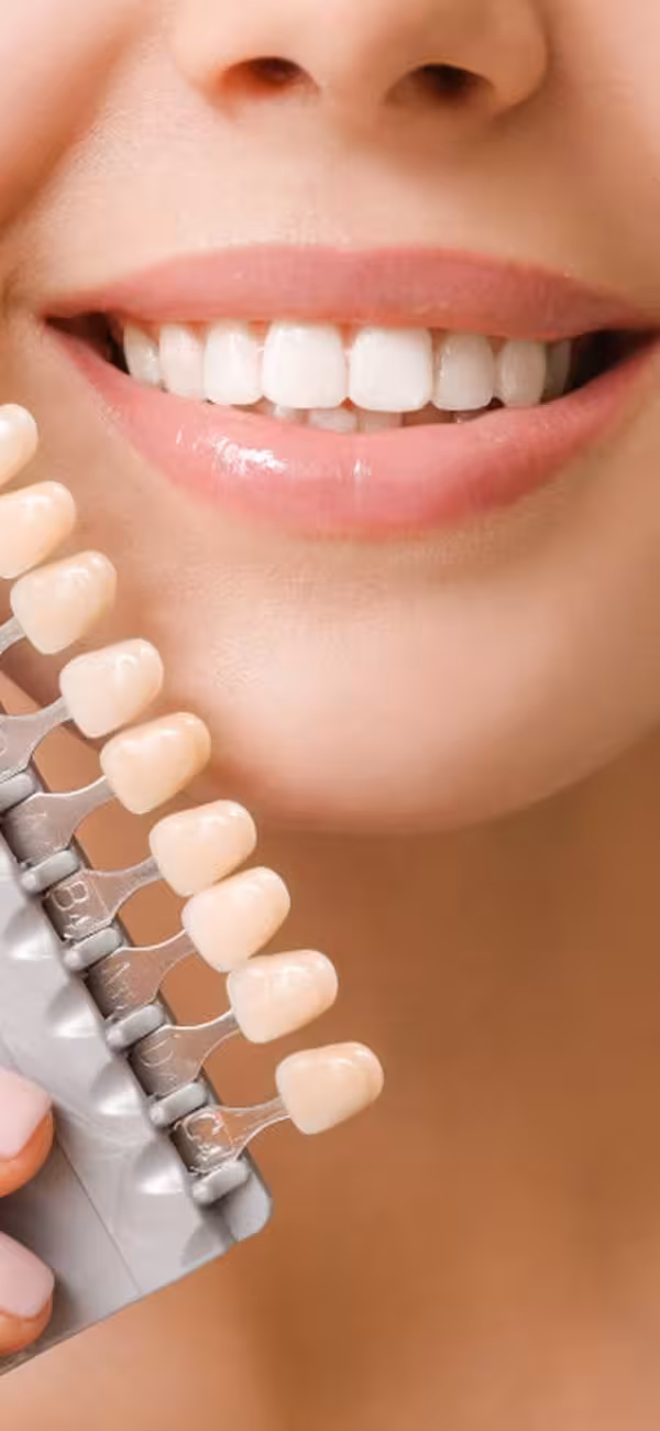 Profesionálne bielenie zubov - pomocou metódy BlancOne